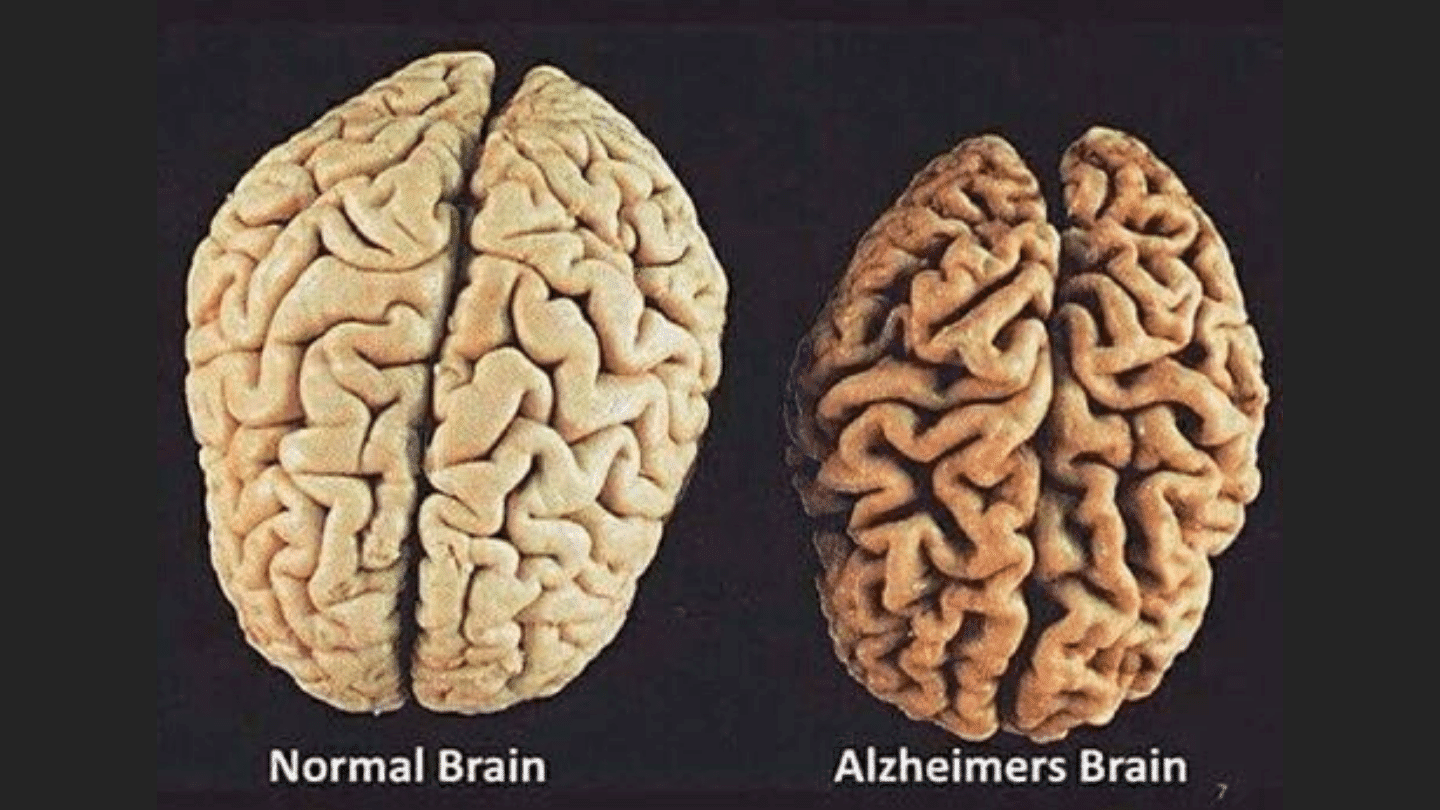 Болезнь Альцгеймера - причины, симптомы, лечение