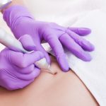 Результаты и риски радиочастотного удаления: шрамы, рецидивы, осложнения